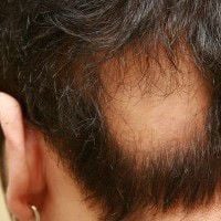 Choroba grzybicza włosów (Objawy i leczenie)