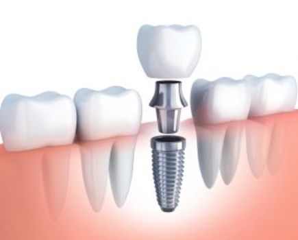 Czy warto zdecydować się na implant zęba?