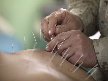 Medycyna niekonwencjonalna - akupunktura