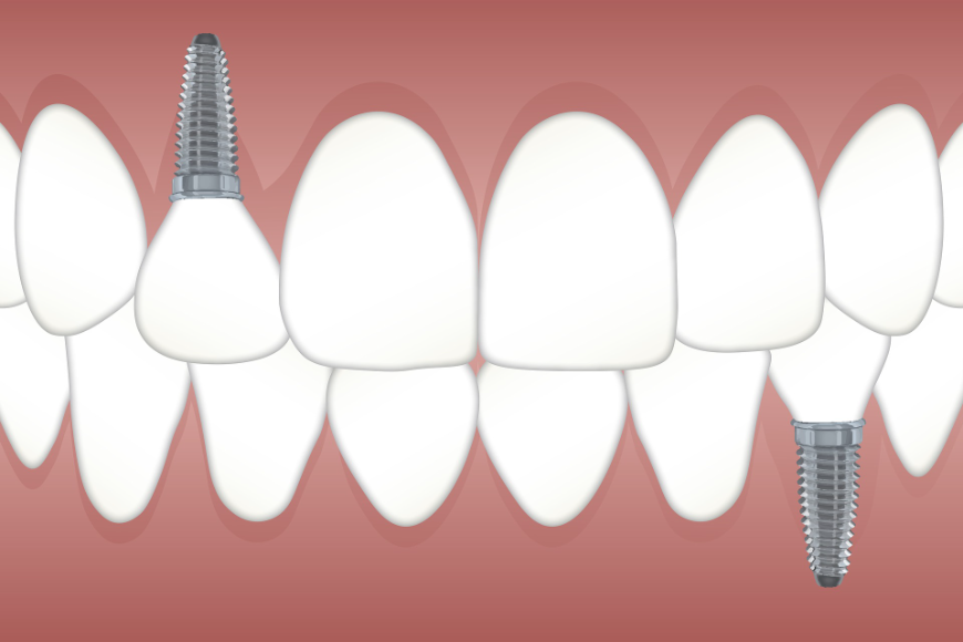 Implanty stomatologiczne – poznaj je bliżej