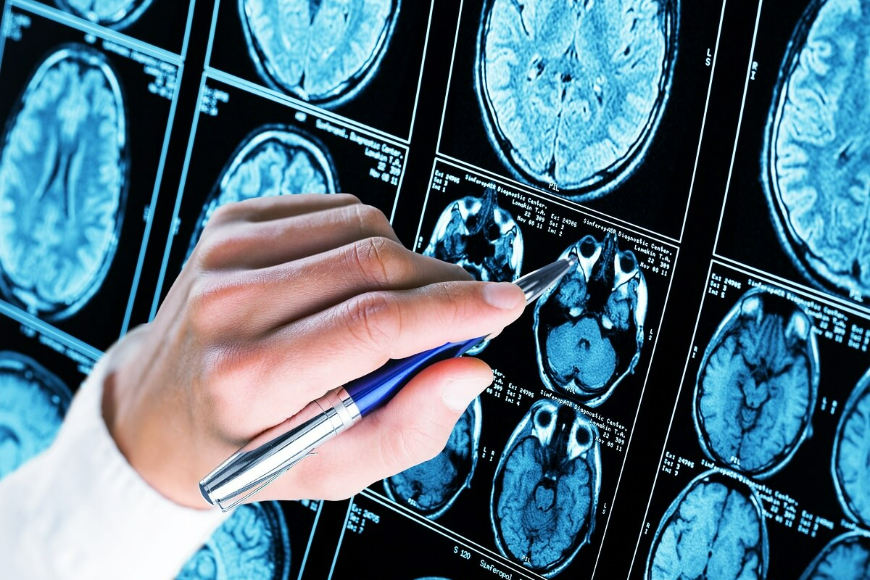 Choroba Alzheimera: Genetyczne i dziedziczne czynniki ryzyka